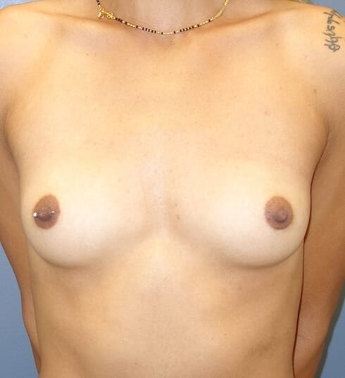 Natural Breast Augmentation - Before 4