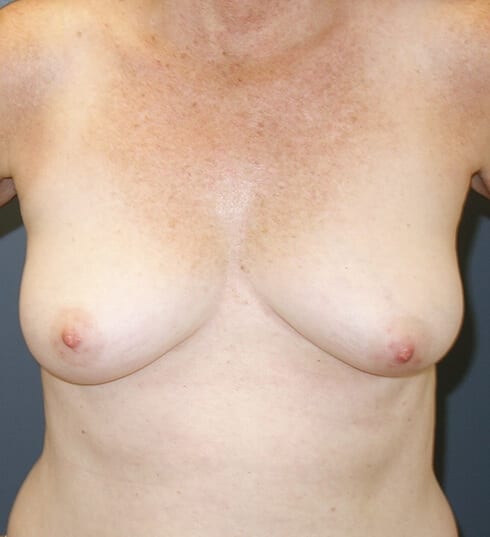 Breast Reconstruction - Before 4