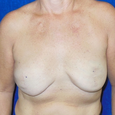 Breast Reconstruction - Before 1