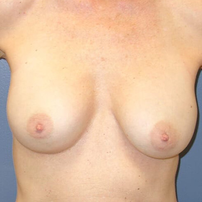 Breast Implant Removal - Before 4