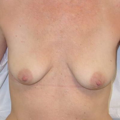 Breast Implant Removal - After 4